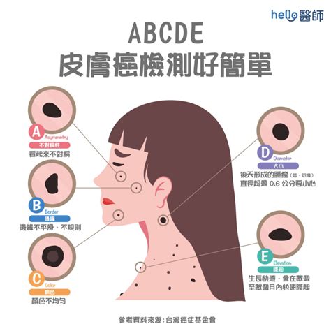 臉上多了痣|痣變大、痣多或長毛會變皮膚癌？認識痣的形成與原因